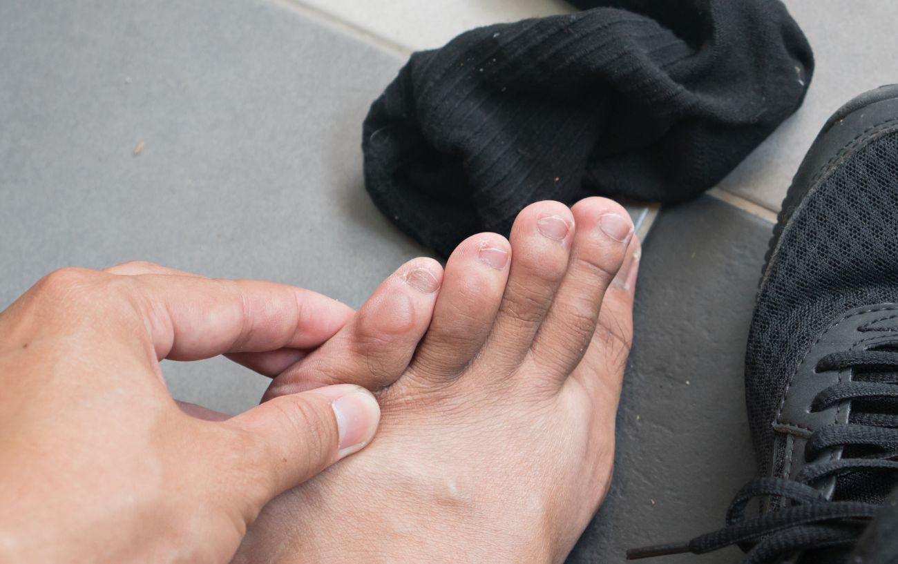 A person with blisters on their baby toe from running.